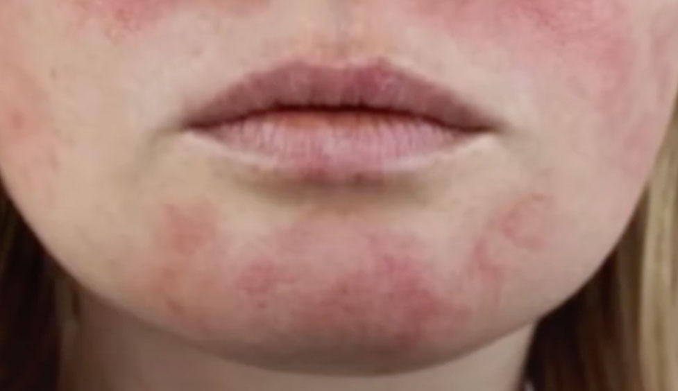 Lúpus Eritematoso Sistêmico: o que é, sintomas e quando procurar um reumatologista
