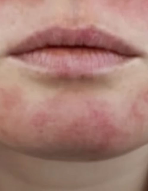 Lúpus Eritematoso Sistêmico: o que é, sintomas e quando procurar um reumatologista Lúpus Eritematoso Sistêmico: o que é, sintomas e quando procurar um reumatologista