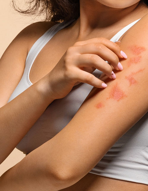 Dia Mundial da Psoríase